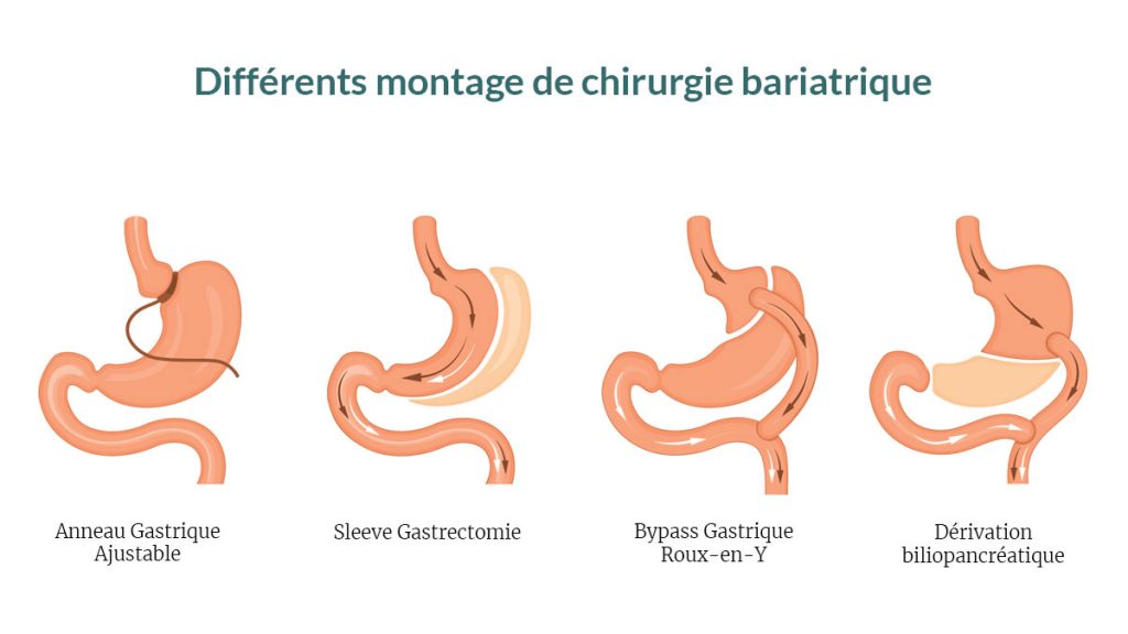 découvrez les solutions de chirurgie pour l'obésité, une approche médicale efficace pour aider à retrouver un poids santé. informez-vous sur les différentes interventions, leurs bénéfices et comment elles peuvent améliorer votre qualité de vie.