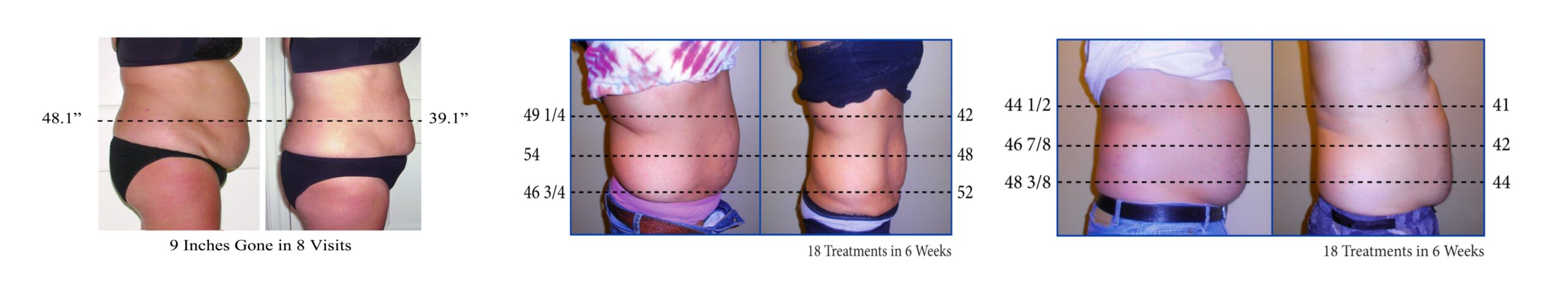 découvrez comment le laser peut vous aider à maigrir efficacement et durablement. cette méthode innovante offre des résultats rapides tout en respectant votre corps. informez-vous sur les avantages et les techniques disponibles pour atteindre vos objectifs de perte de poids.